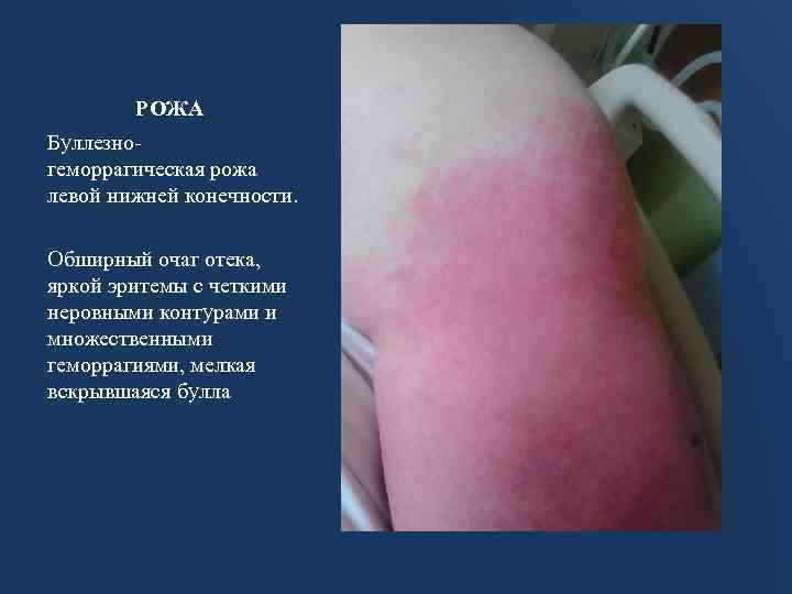 РОЖА Буллезногеморрагическая рожа левой нижней конечности. Обширный очаг отека, яркой эритемы с четкими неровными