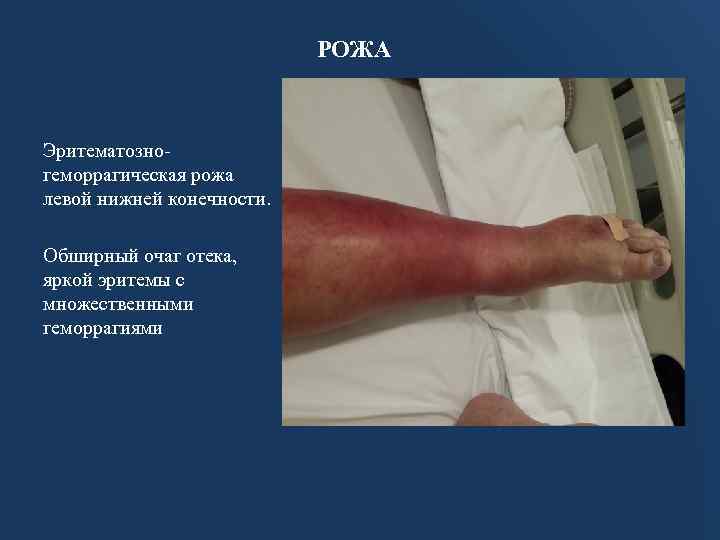 РОЖА Эритематозногеморрагическая рожа левой нижней конечности. Обширный очаг отека, яркой эритемы с множественными геморрагиями
