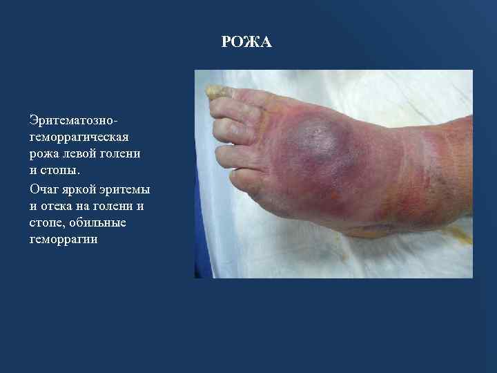 РОЖА Эритематозногеморрагическая рожа левой голени и стопы. Очаг яркой эритемы и отека на голени
