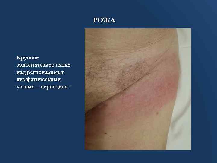 РОЖА Крупное эритематозное пятно над регионарными лимфатическими узлами – периаденит 