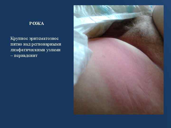 РОЖА Крупное эритематозное пятно над регионарными лимфатическими узлами – периаденит 