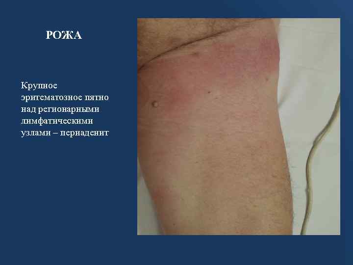 РОЖА Крупное эритематозное пятно над регионарными лимфатическими узлами – периаденит 