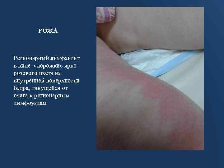 РОЖА Регионарный лимфангит в виде «дорожки» яркорозового цвета на внутренней поверхности бедра, тянущейся от