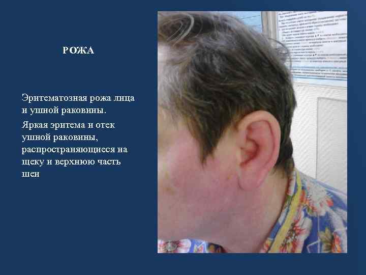 РОЖА Эритематозная рожа лица и ушной раковины. Яркая эритема и отек ушной раковины, распространяющиеся