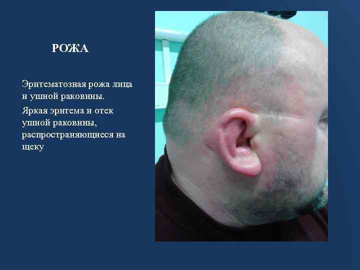 РОЖА Эритематозная рожа лица и ушной раковины. Яркая эритема и отек ушной раковины, распространяющиеся