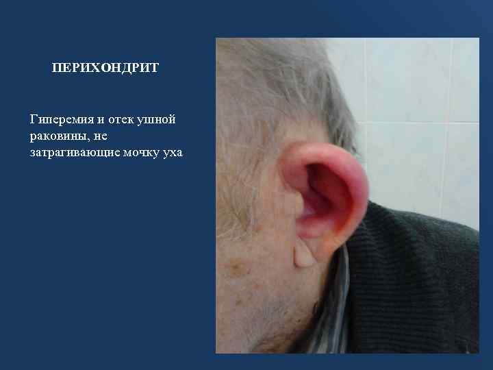ПЕРИХОНДРИТ Гиперемия и отек ушной раковины, не затрагивающие мочку уха 
