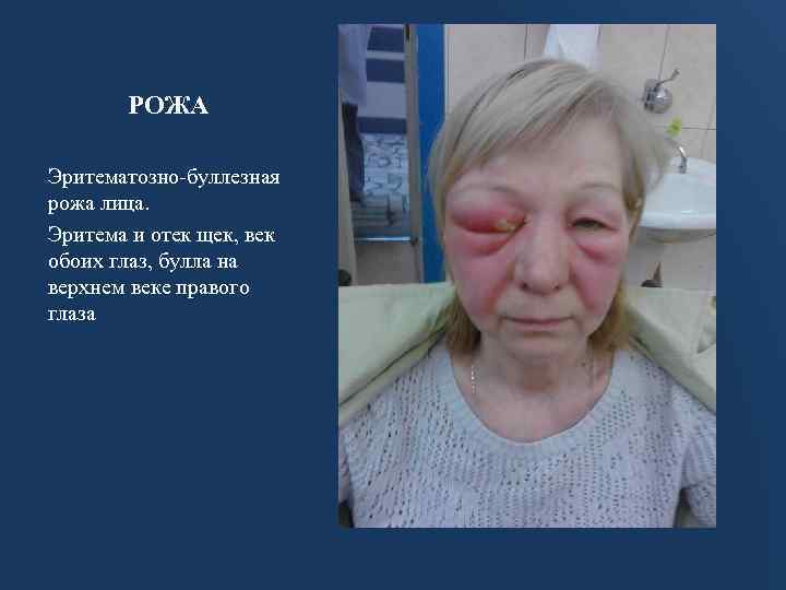 РОЖА Эритематозно-буллезная рожа лица. Эритема и отек щек, век обоих глаз, булла на верхнем