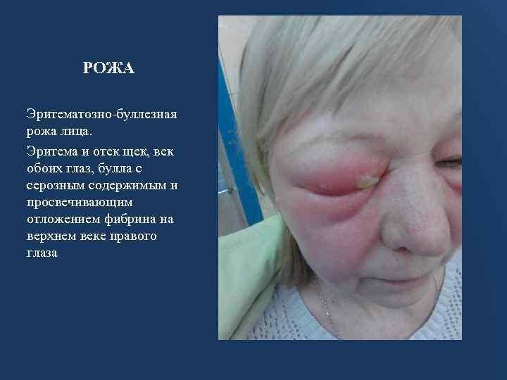 РОЖА Эритематозно-буллезная рожа лица. Эритема и отек щек, век обоих глаз, булла с серозным