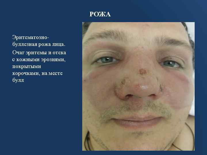 РОЖА Эритематознобуллезная рожа лица. Очаг эритемы и отека с кожными эрозиями, покрытыми корочками, на