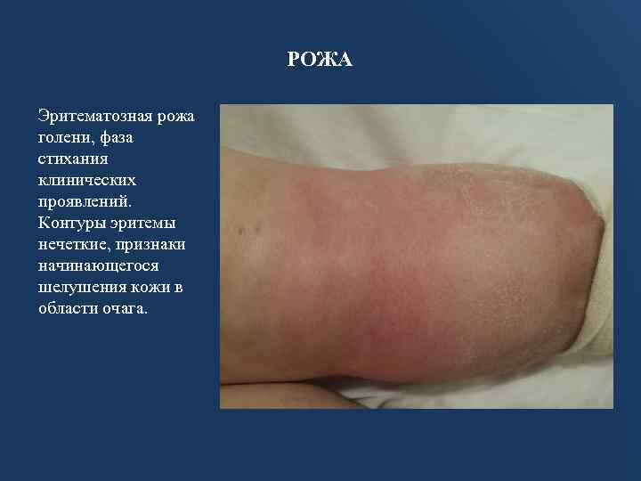 РОЖА Эритематозная рожа голени, фаза стихания клинических проявлений. Контуры эритемы нечеткие, признаки начинающегося шелушения