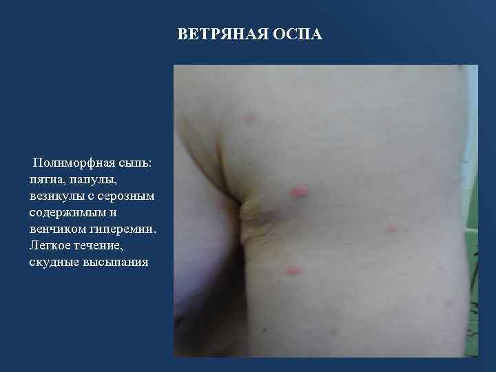 ВЕТРЯНАЯ ОСПА Полиморфная сыпь: пятна, папулы, везикулы с серозным содержимым и венчиком гиперемии. Легкое