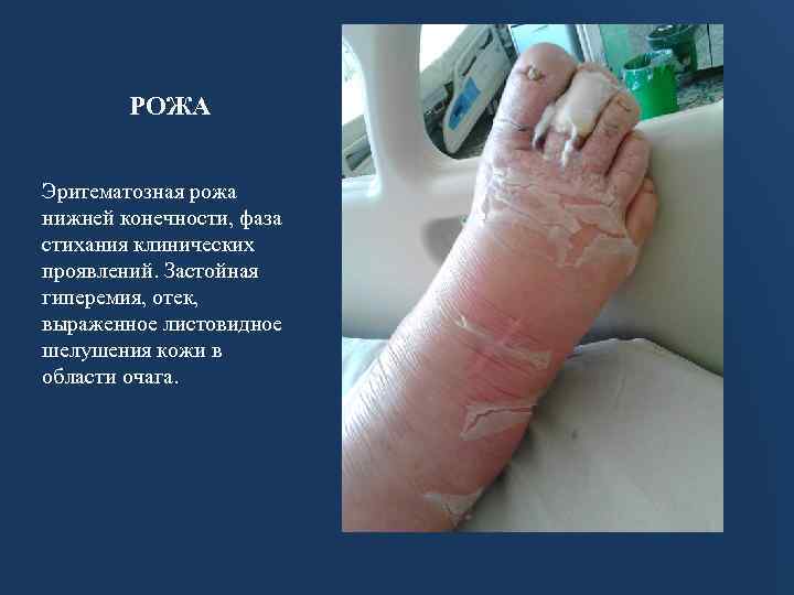 РОЖА Эритематозная рожа нижней конечности, фаза стихания клинических проявлений. Застойная гиперемия, отек, выраженное листовидное