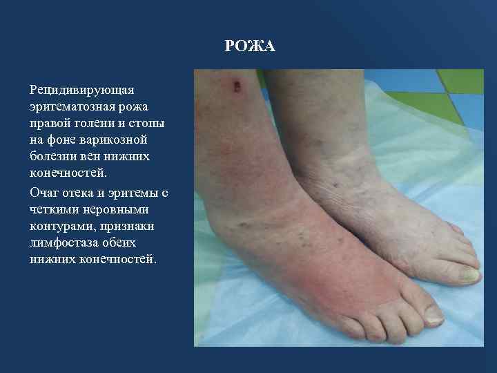 РОЖА Рецидивирующая эритематозная рожа правой голени и стопы на фоне варикозной болезни вен нижних