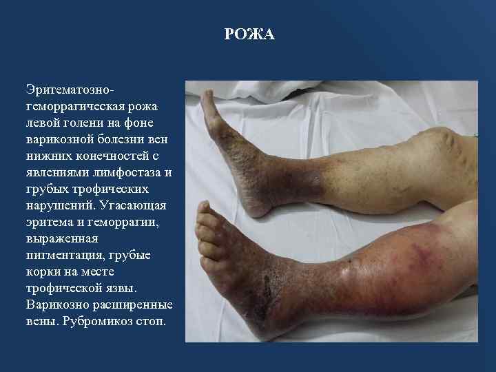 РОЖА Эритематозногеморрагическая рожа левой голени на фоне варикозной болезни вен нижних конечностей с явлениями