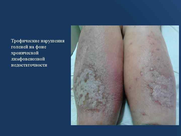 Трофические нарушения голеней на фоне хронической лимфовенозной недостаточности 