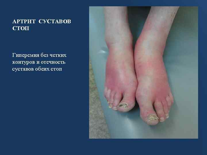 АРТРИТ СУСТАВОВ СТОП Гиперемия без четких контуров и отечность суставов обеих стоп 