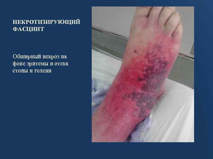НЕКРОТИЗИРУЮЩИЙ ФАСЦИИТ Обширный некроз на фоне эритемы и отека стопы и голени 