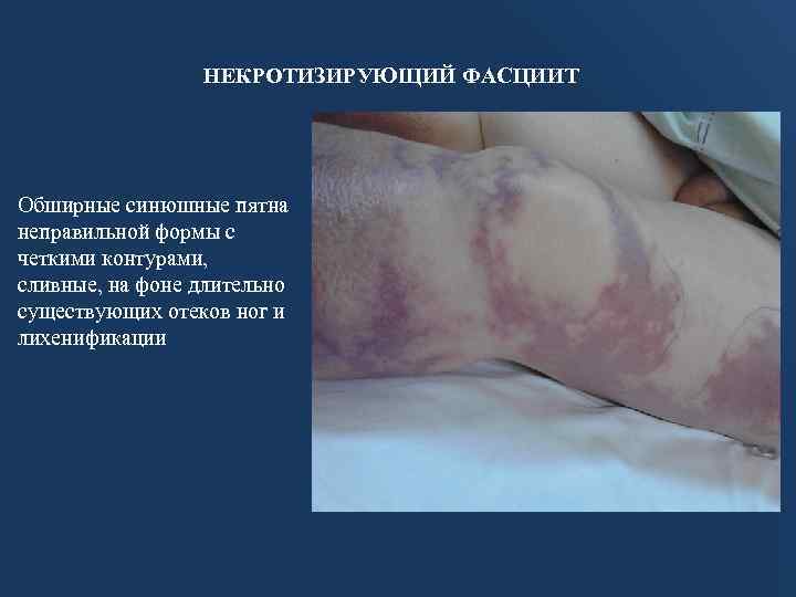 НЕКРОТИЗИРУЮЩИЙ ФАСЦИИТ Обширные синюшные пятна неправильной формы с четкими контурами, сливные, на фоне длительно