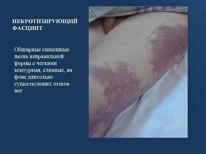 НЕКРОТИЗИРУЮЩИЙ ФАСЦИИТ Обширные синюшные пятна неправильной формы с четкими контурами, сливные, на фоне длительно