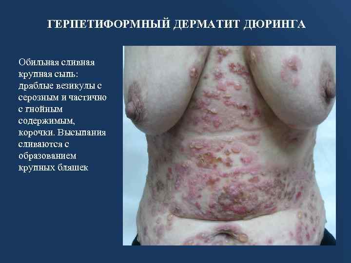 ГЕРПЕТИФОРМНЫЙ ДЕРМАТИТ ДЮРИНГА Обильная сливная крупная сыпь: дряблые везикулы с серозным и частично с