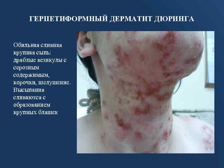 ГЕРПЕТИФОРМНЫЙ ДЕРМАТИТ ДЮРИНГА Обильная сливная крупная сыпь: дряблые везикулы с серозным содержимым, корочки, шелушение.