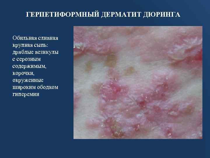 ГЕРПЕТИФОРМНЫЙ ДЕРМАТИТ ДЮРИНГА Обильная сливная крупная сыпь: дряблые везикулы с серозным содержимым, корочки, окруженные