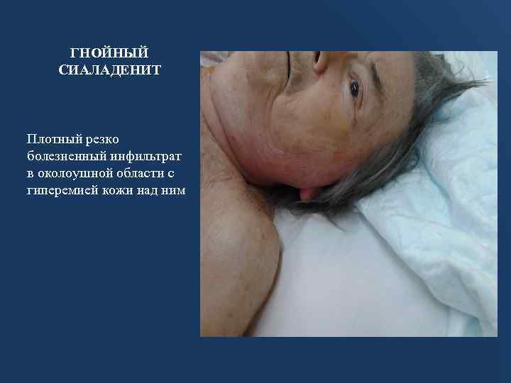 ГНОЙНЫЙ СИАЛАДЕНИТ Плотный резко болезненный инфильтрат в околоушной области с гиперемией кожи над ним