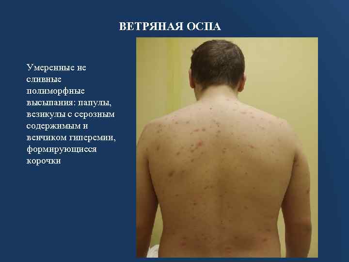 ВЕТРЯНАЯ ОСПА Умеренные не сливные полиморфные высыпания: папулы, везикулы с серозным содержимым и венчиком