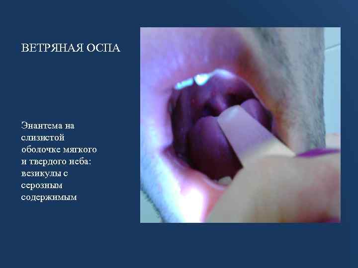 ВЕТРЯНАЯ ОСПА Энантема на слизистой оболочке мягкого и твердого неба: везикулы с серозным содержимым