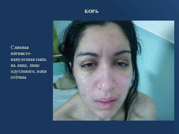 КОРЬ Сливная пятнистопапулезная сыпь на лице, лицо одутловато, веки отёчны 
