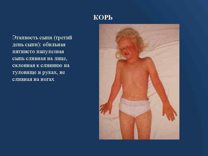 КОРЬ Этапность сыпи (третий день сыпи): обильная пятнисто папулезная сыпь сливная на лице, склонная