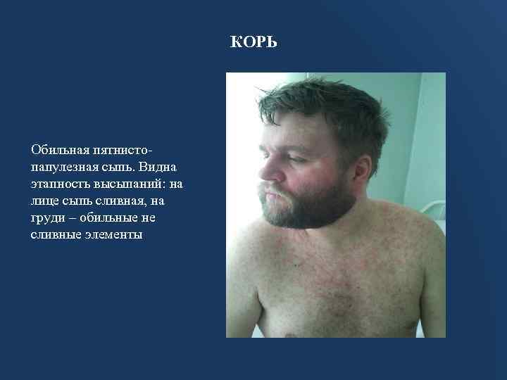 КОРЬ Обильная пятнистопапулезная сыпь. Видна этапность высыпаний: на лице сыпь сливная, на груди –