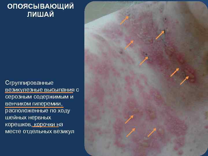 ОПОЯСЫВАЮЩИЙ ЛИШАЙ Сгруппированные везикулезные высыпания с серозным содержимым и венчиком гиперемии, расположенные по ходу