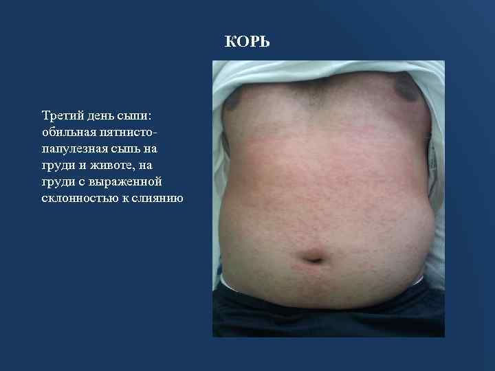 КОРЬ Третий день сыпи: обильная пятнистопапулезная сыпь на груди и животе, на груди с