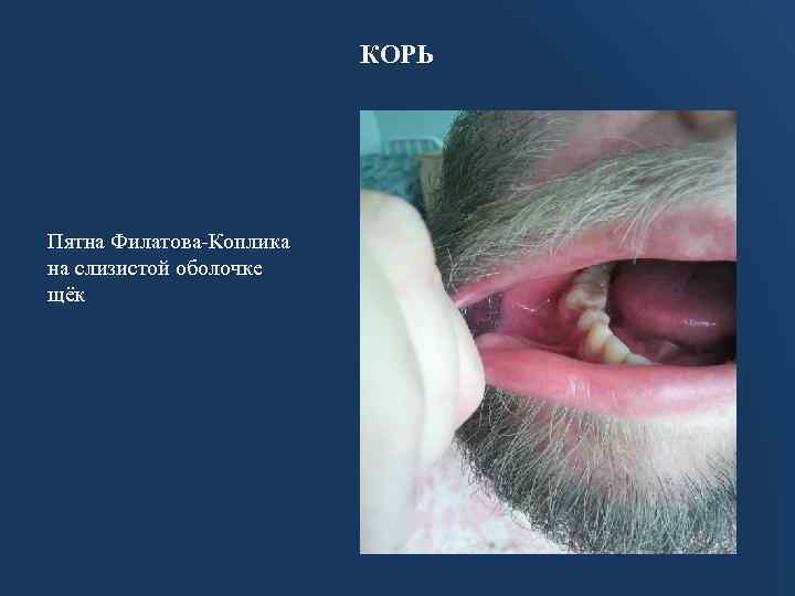 КОРЬ Пятна Филатова-Коплика на слизистой оболочке щёк 