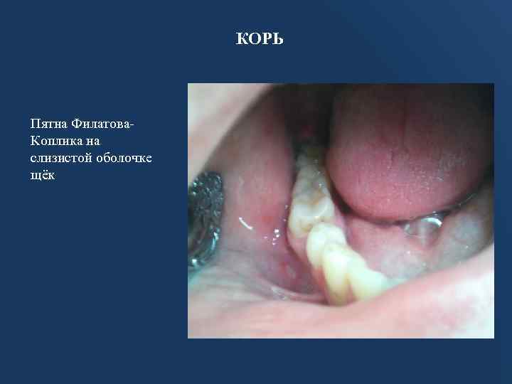 КОРЬ Пятна Филатова. Коплика на слизистой оболочке щёк 