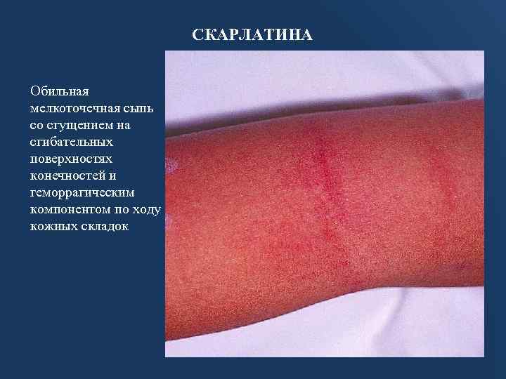 СКАРЛАТИНА Обильная мелкоточечная сыпь со сгущением на сгибательных поверхностях конечностей и геморрагическим компонентом по