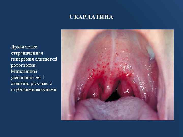 СКАРЛАТИНА Яркая четко отграниченная гиперемия слизистой ротоглотки. Миндалины увеличены до 1 степени, рыхлые, с