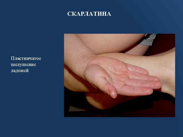 СКАРЛАТИНА Пластинчатое шелушение ладоней 