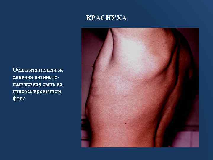 КРАСНУХА Обильная мелкая не сливная пятнистопапулезная сыпь на гиперемированном фоне 