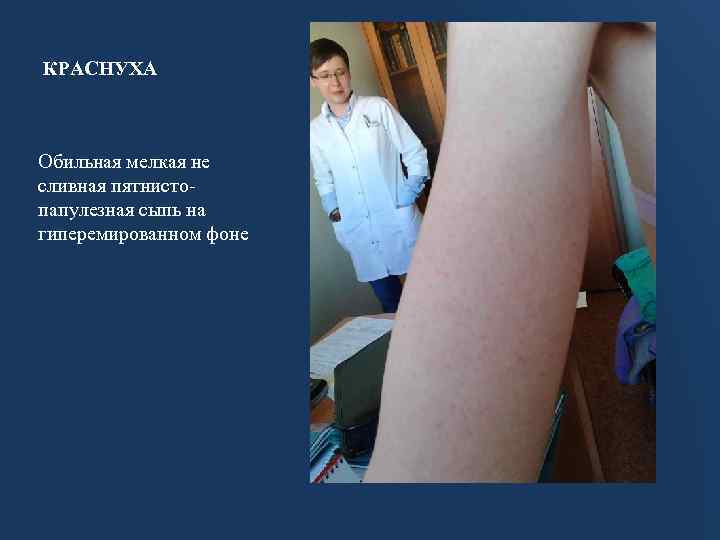 КРАСНУХА Обильная мелкая не сливная пятнистопапулезная сыпь на гиперемированном фоне 