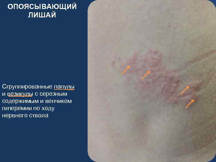 ОПОЯСЫВАЮЩИЙ ЛИШАЙ Сгруппированные папулы и везикулы с серозным содержимым и венчиком гиперемии по ходу