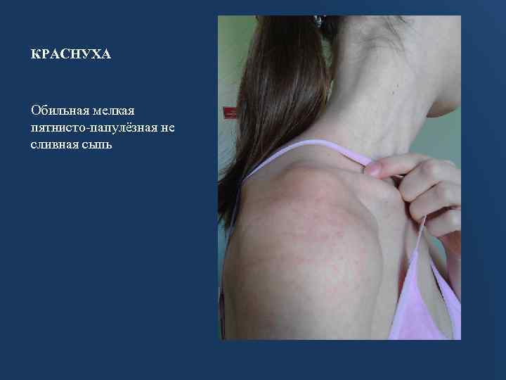 КРАСНУХА Обильная мелкая пятнисто-папулёзная не сливная сыпь 
