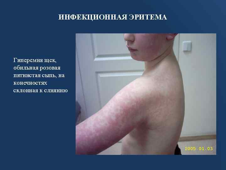 ИНФЕКЦИОННАЯ ЭРИТЕМА Гиперемия щек, обильная розовая пятнистая сыпь, на конечностях склонная к слиянию 