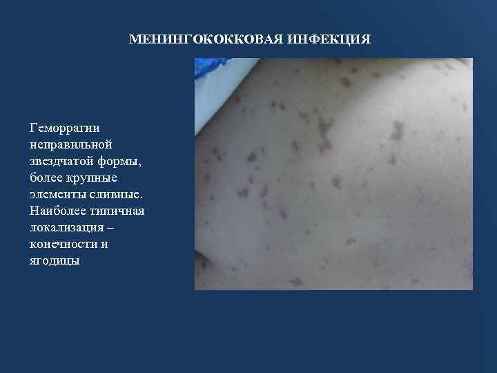 МЕНИНГОКОККОВАЯ ИНФЕКЦИЯ Геморрагии неправильной звездчатой формы, более крупные элементы сливные. Наиболее типичная локализация –