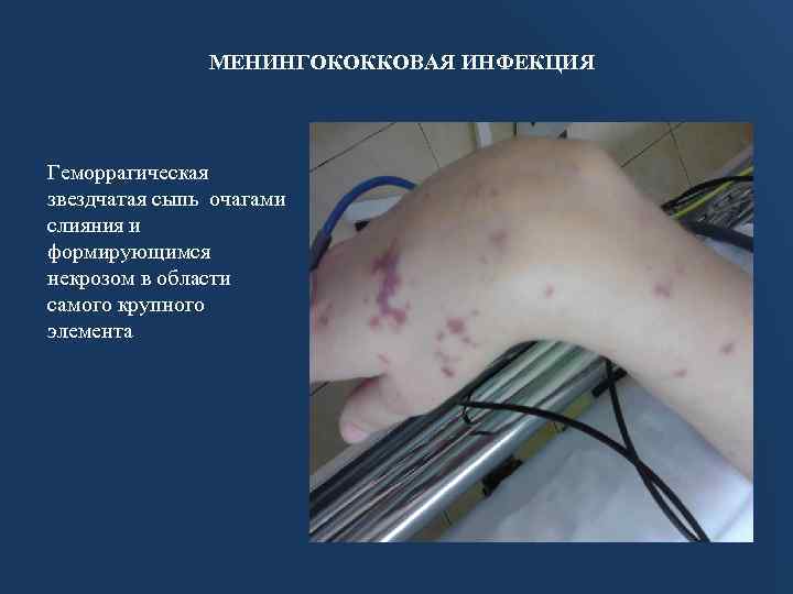 МЕНИНГОКОККОВАЯ ИНФЕКЦИЯ Геморрагическая звездчатая сыпь очагами слияния и формирующимся некрозом в области самого крупного
