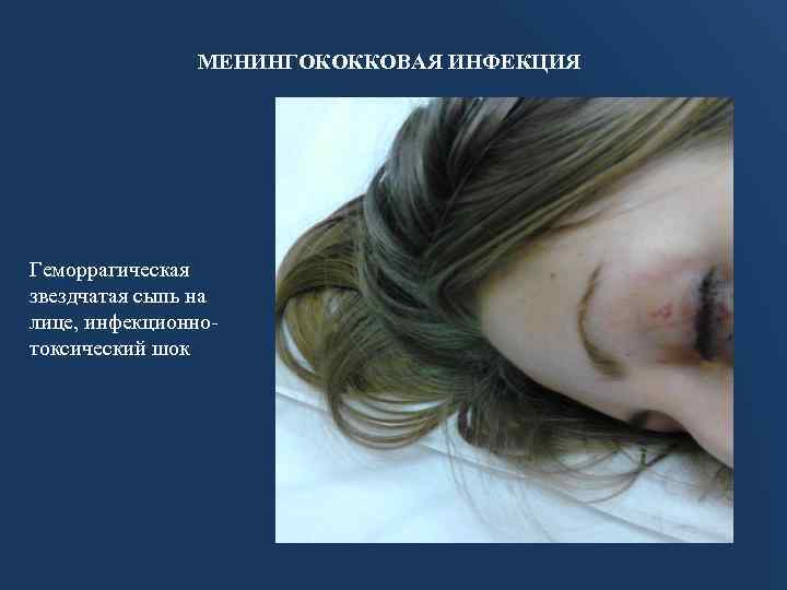 МЕНИНГОКОККОВАЯ ИНФЕКЦИЯ Геморрагическая звездчатая сыпь на лице, инфекционнотоксический шок 