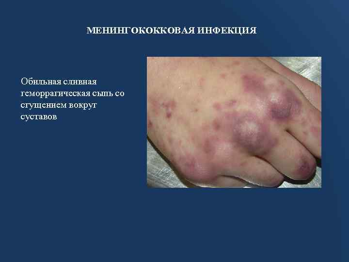МЕНИНГОКОККОВАЯ ИНФЕКЦИЯ Обильная сливная геморрагическая сыпь со сгущением вокруг суставов 