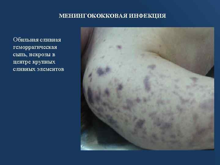 МЕНИНГОКОККОВАЯ ИНФЕКЦИЯ Обильная сливная геморрагическая сыпь, некрозы в центре крупных сливных элементов 