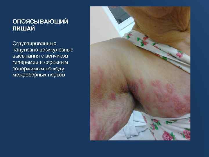 ОПОЯСЫВАЮЩИЙ ЛИШАЙ Сгруппированные папулезно-везикулезные высыпания с венчиком гиперемии и серозным содержимым по ходу межреберных
